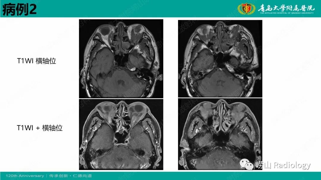 【病例】Rosai-Dorfman病 & 套细胞淋巴瘤-10