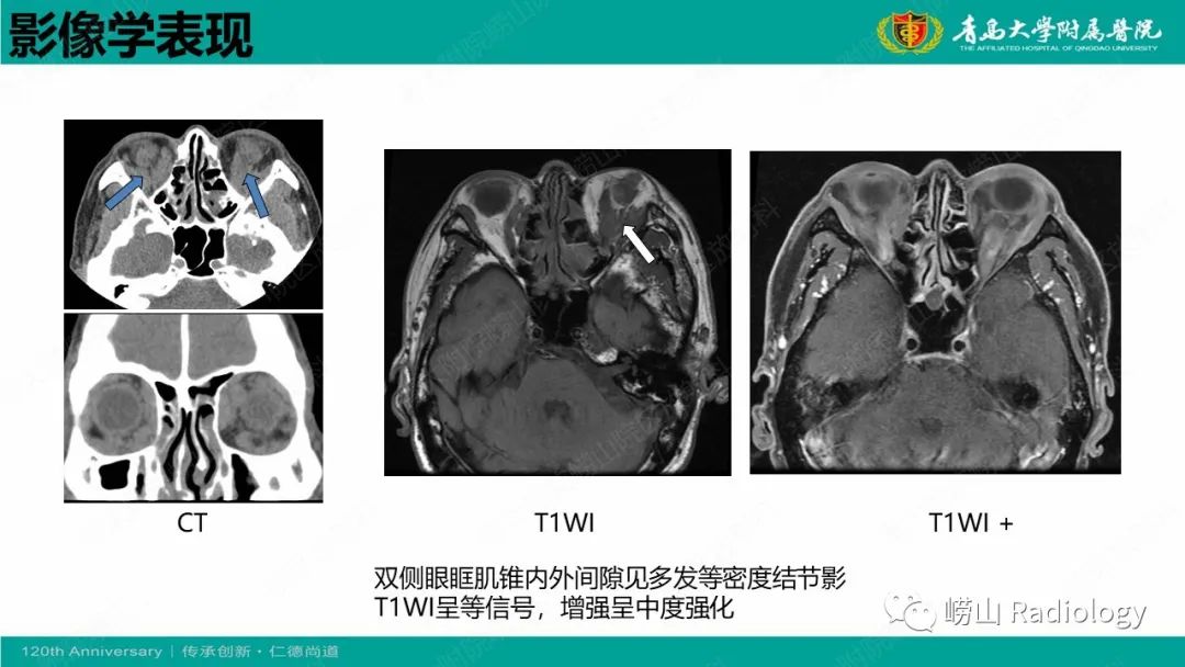 【病例】Rosai-Dorfman病 & 套细胞淋巴瘤-33
