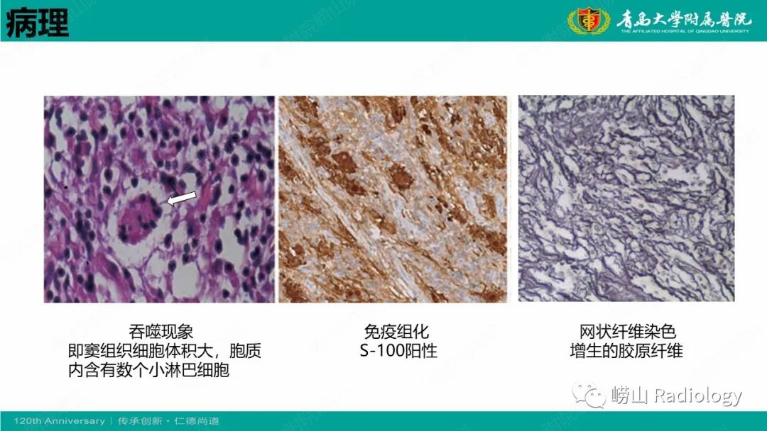 【病例】Rosai-Dorfman病 & 套细胞淋巴瘤-16