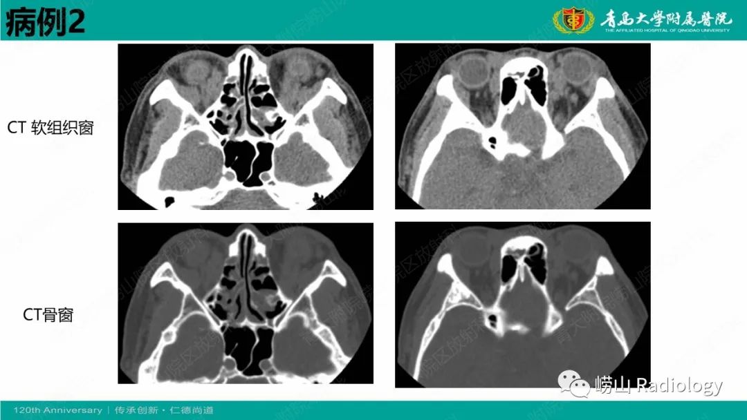 【病例】Rosai-Dorfman病 & 套细胞淋巴瘤-8