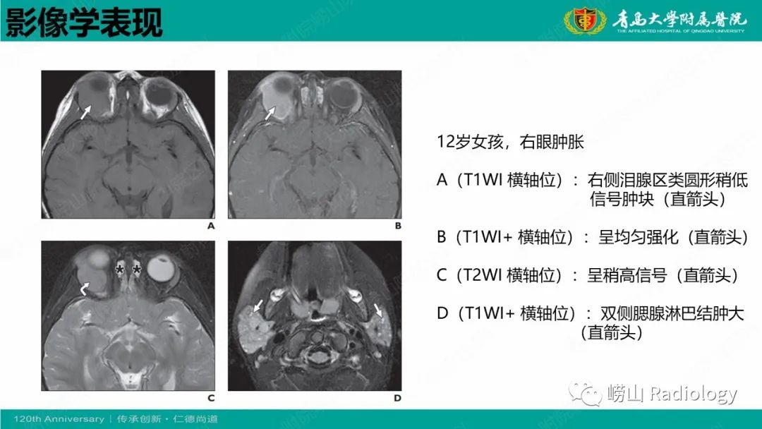 【病例】Rosai-Dorfman病 & 套细胞淋巴瘤-25