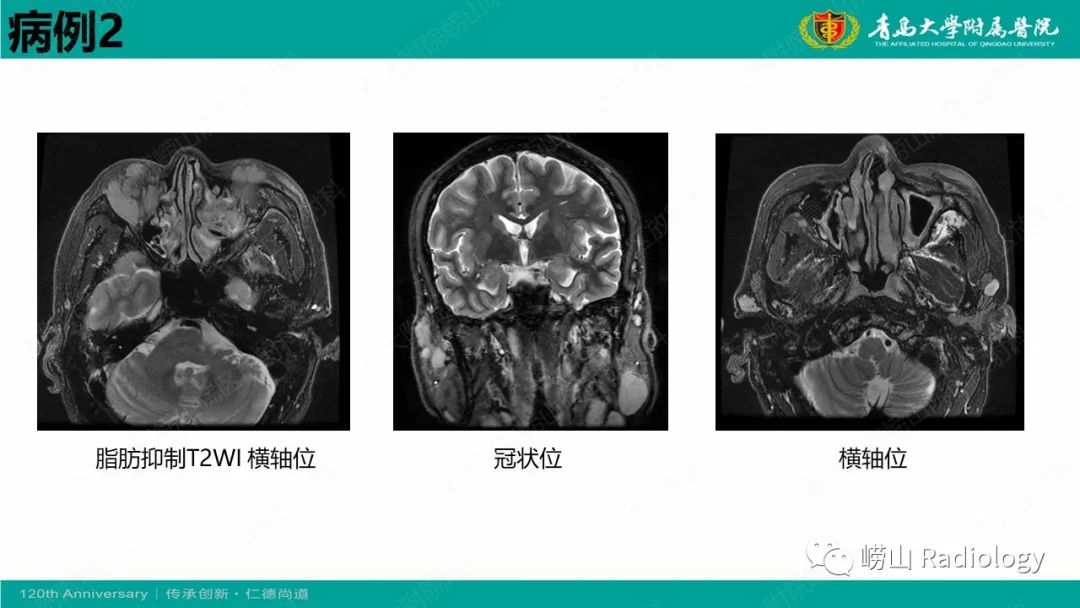 【病例】Rosai-Dorfman病 & 套细胞淋巴瘤-13