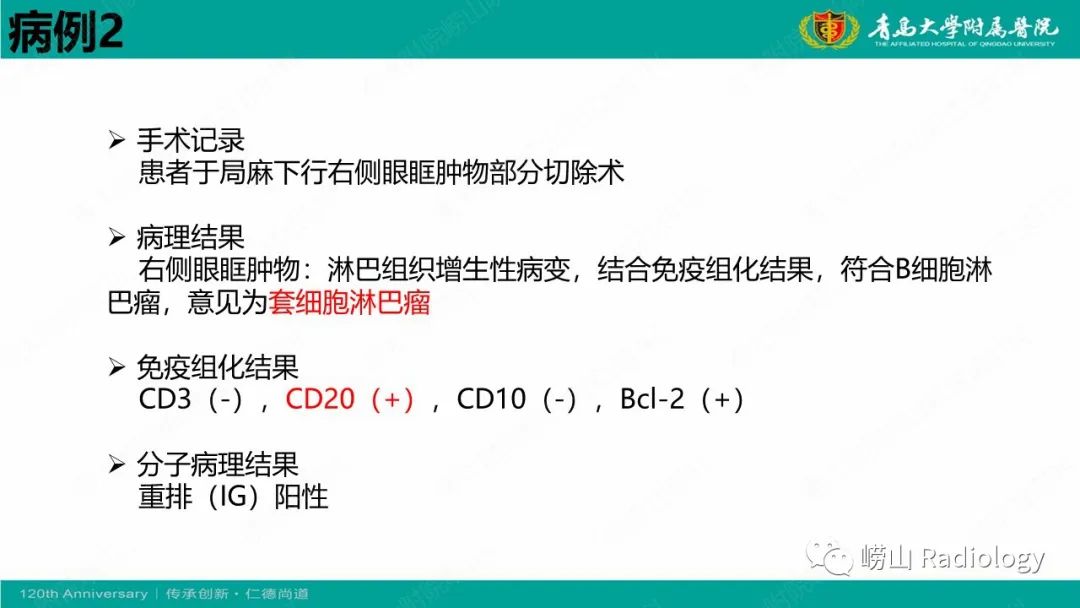 【病例】Rosai-Dorfman病 & 套细胞淋巴瘤-28