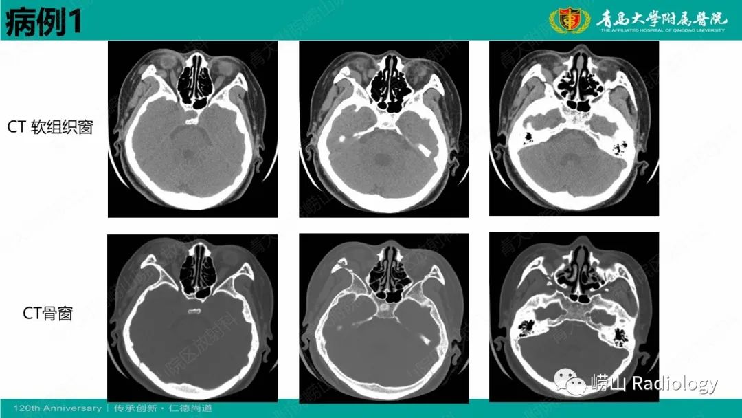 【病例】Rosai-Dorfman病 & 套细胞淋巴瘤-4