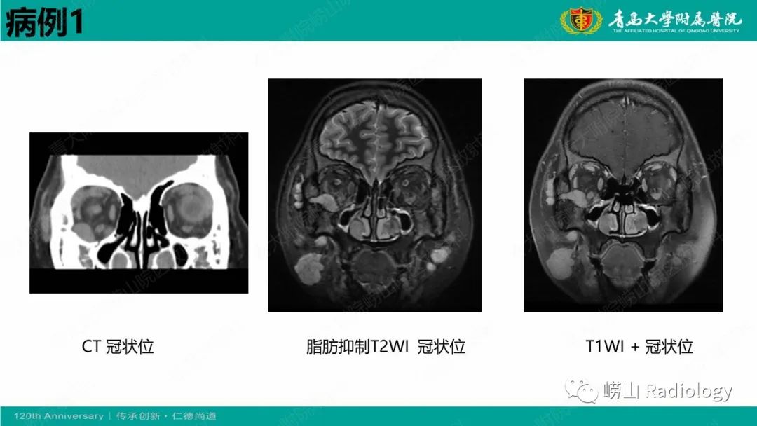 【病例】Rosai-Dorfman病 & 套细胞淋巴瘤-6