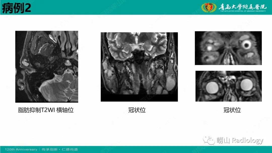 【病例】Rosai-Dorfman病 & 套细胞淋巴瘤-11