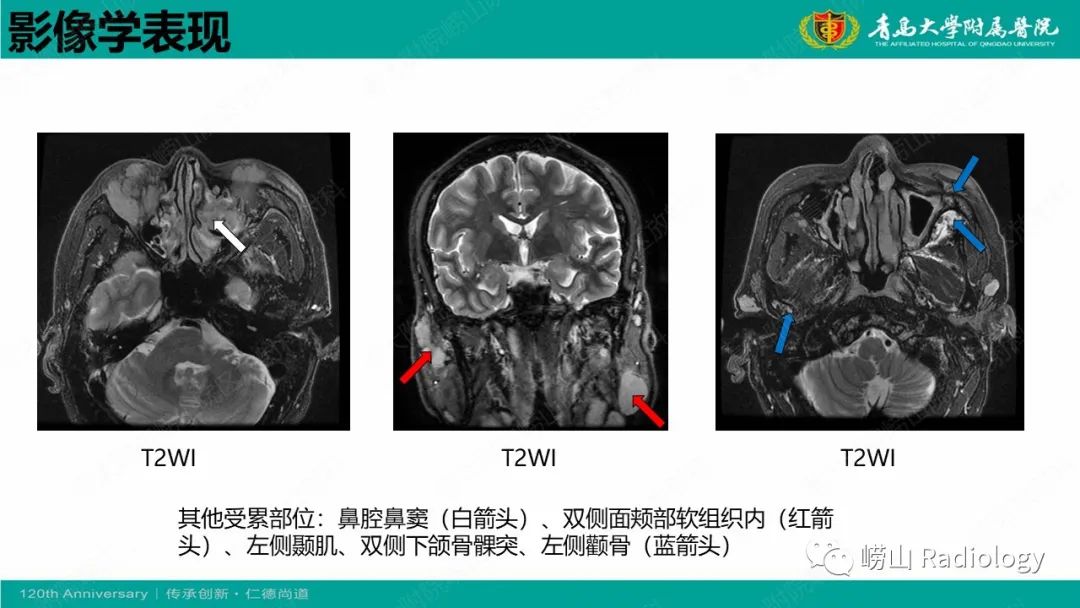 【病例】Rosai-Dorfman病 & 套细胞淋巴瘤-37