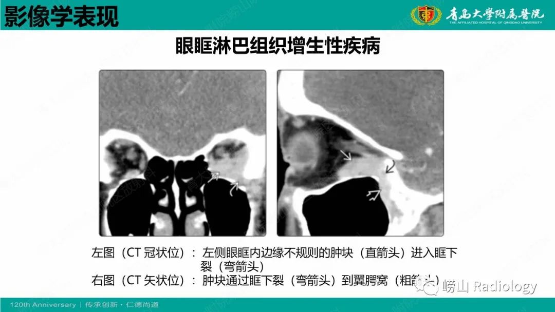 【病例】Rosai-Dorfman病 & 套细胞淋巴瘤-39