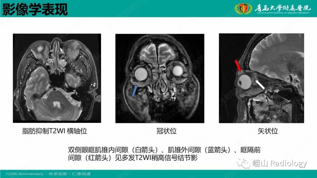 【病例】Rosai-Dorfman病 & 套细胞淋巴瘤-34
