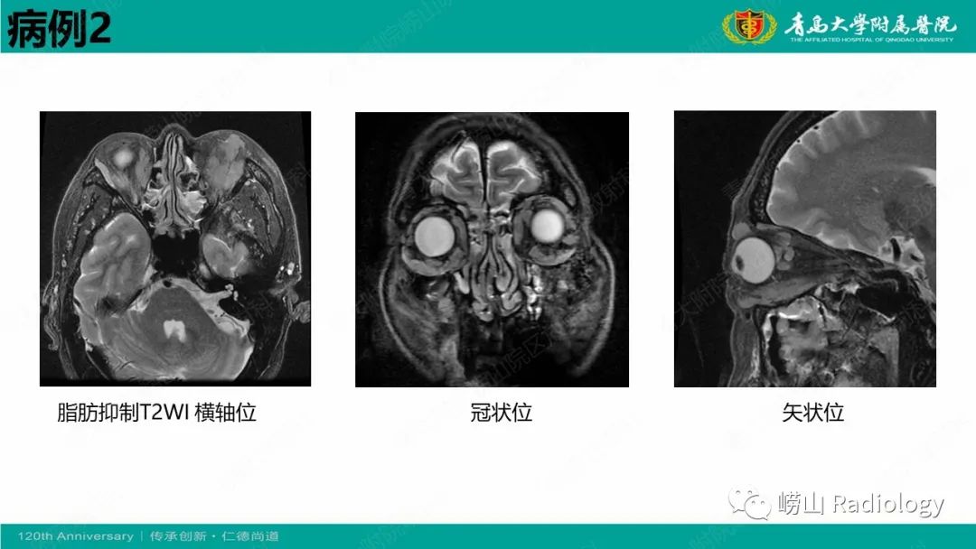 【病例】Rosai-Dorfman病 & 套细胞淋巴瘤-9