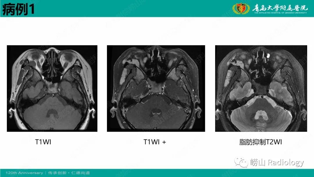 【病例】Rosai-Dorfman病 & 套细胞淋巴瘤-5