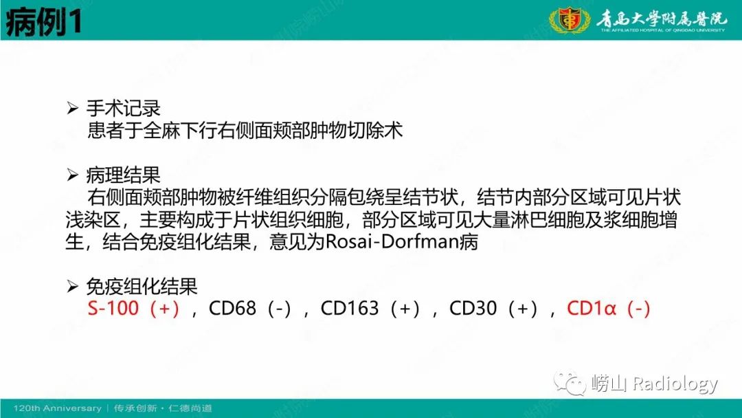【病例】Rosai-Dorfman病 & 套细胞淋巴瘤-14