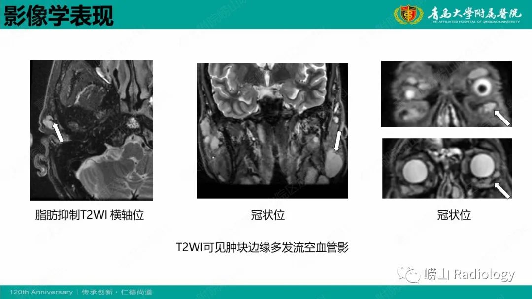 【病例】Rosai-Dorfman病 & 套细胞淋巴瘤-35