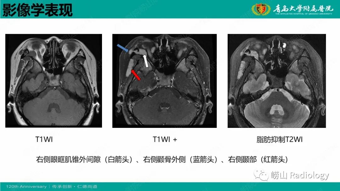 【病例】Rosai-Dorfman病 & 套细胞淋巴瘤-21
