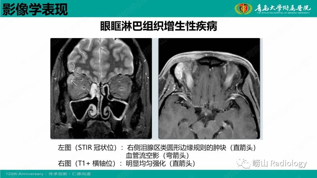 【病例】Rosai-Dorfman病 & 套细胞淋巴瘤-38