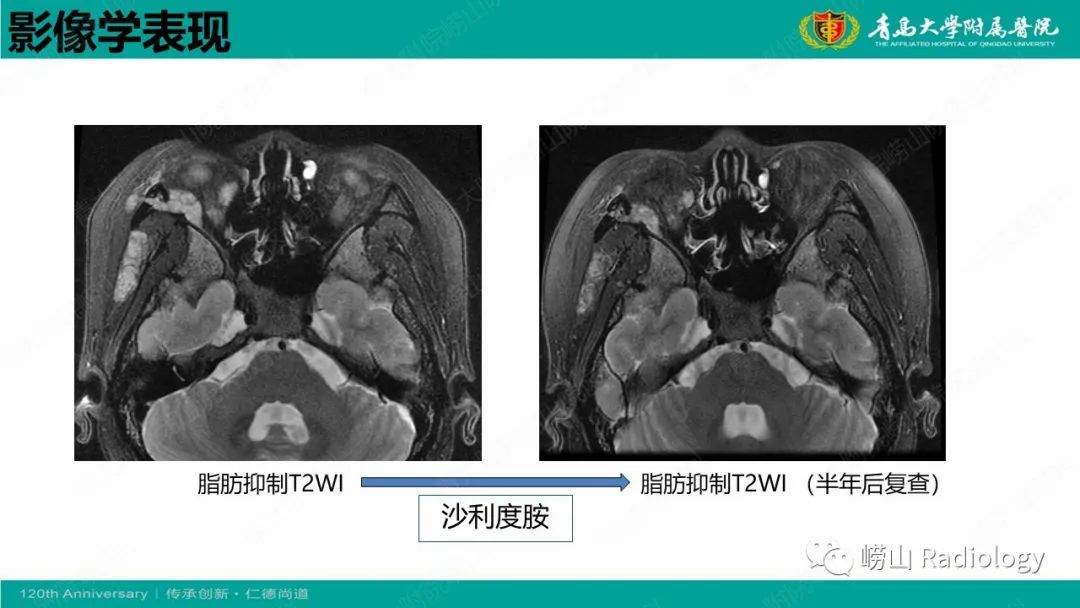 【病例】Rosai-Dorfman病 & 套细胞淋巴瘤-24