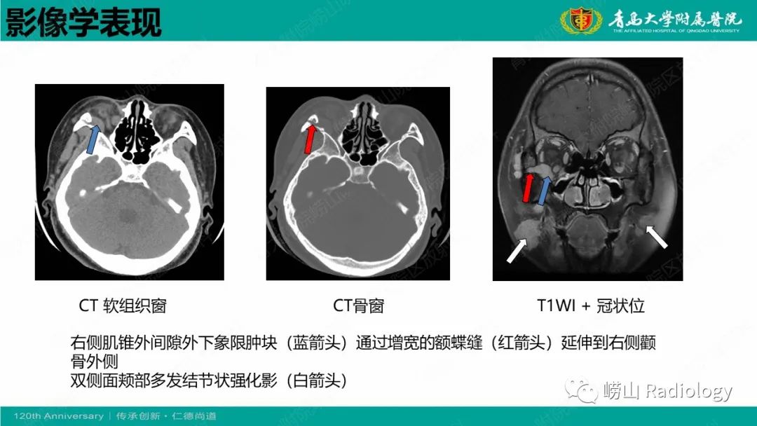 【病例】Rosai-Dorfman病 & 套细胞淋巴瘤-22