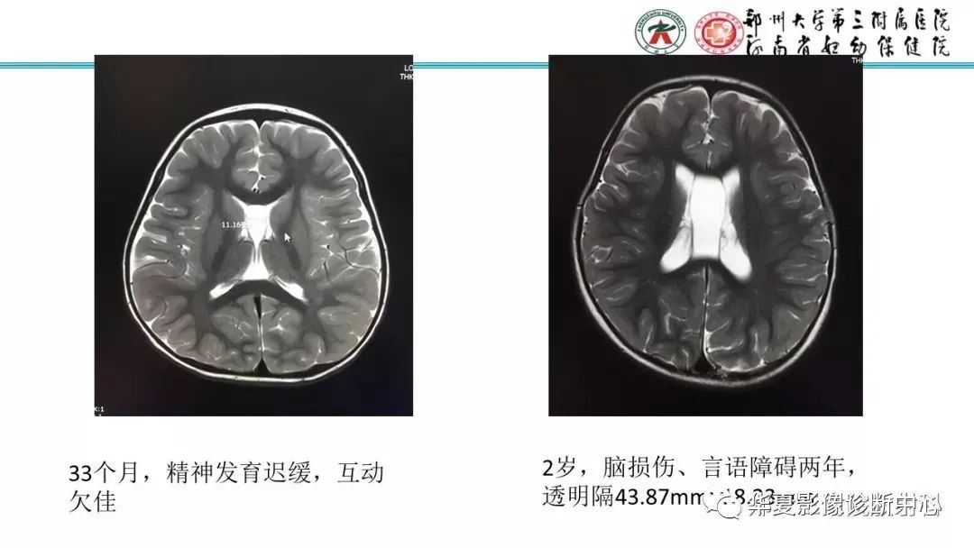 【PPT】透明隔腔的影像表现及临床意义-21