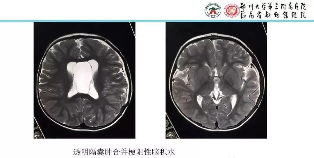 【PPT】透明隔腔的影像表现及临床意义-23