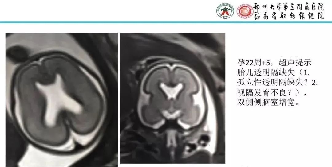 【PPT】透明隔腔的影像表现及临床意义-11