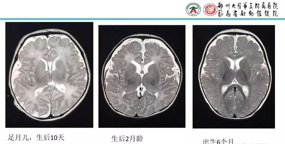 【PPT】透明隔腔的影像表现及临床意义-16