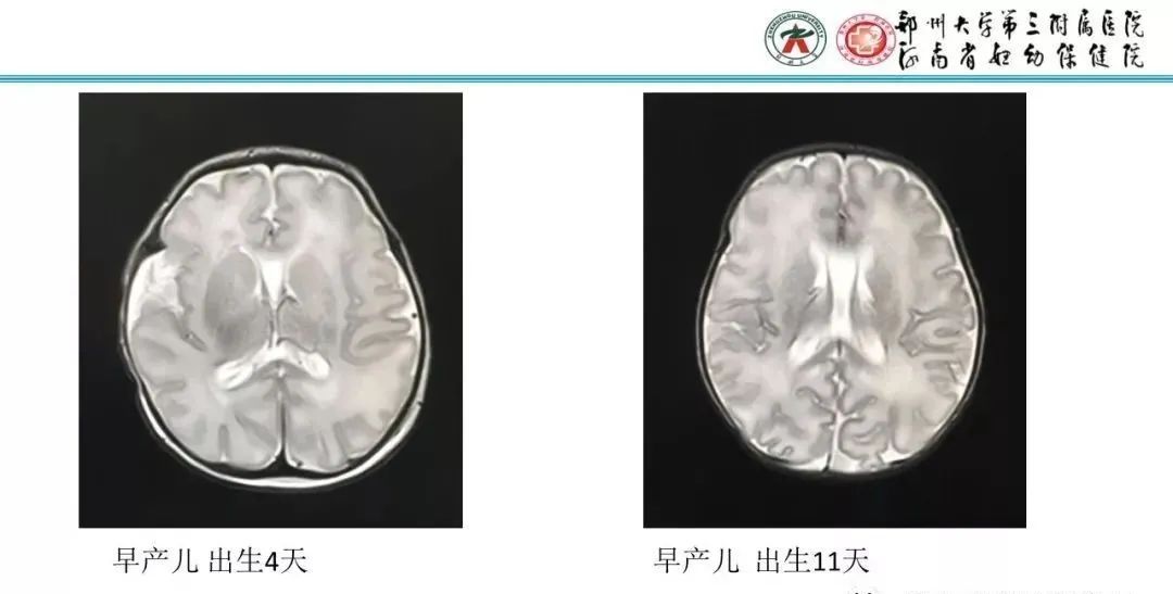 【PPT】透明隔腔的影像表现及临床意义-15