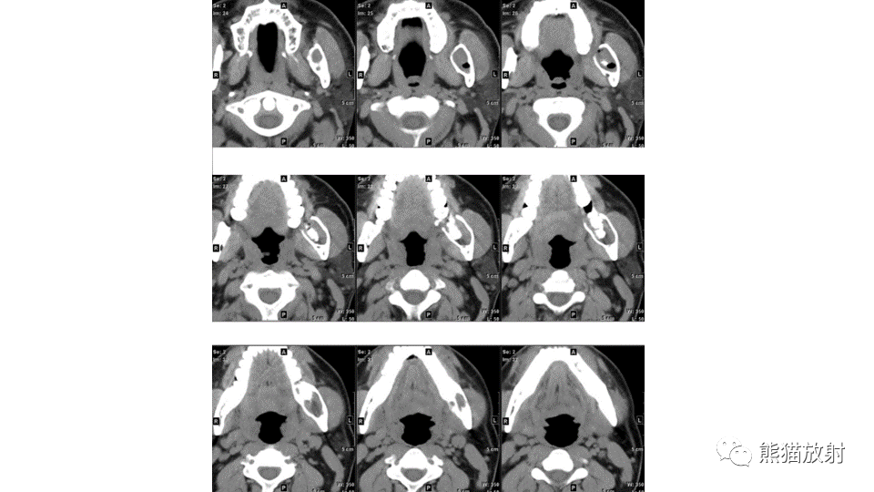 【病例】下颌骨成釉细胞瘤2例CT-11