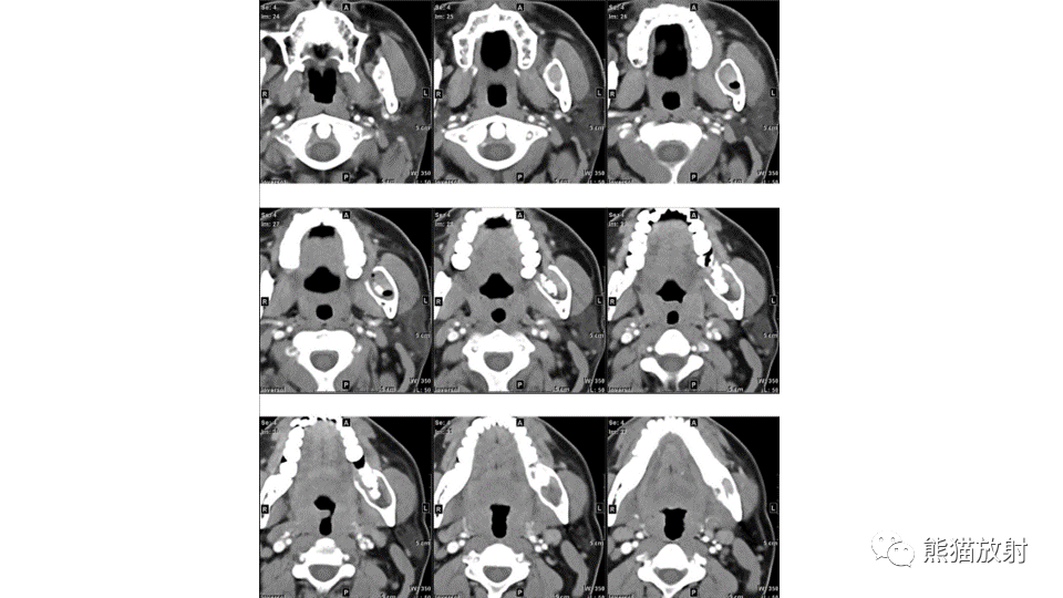 【病例】下颌骨成釉细胞瘤2例CT-13