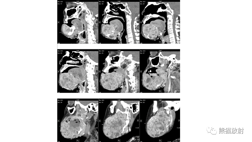 【病例】下颌骨成釉细胞瘤2例CT-7