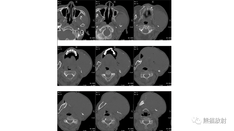 【病例】下颌骨成釉细胞瘤2例CT-4