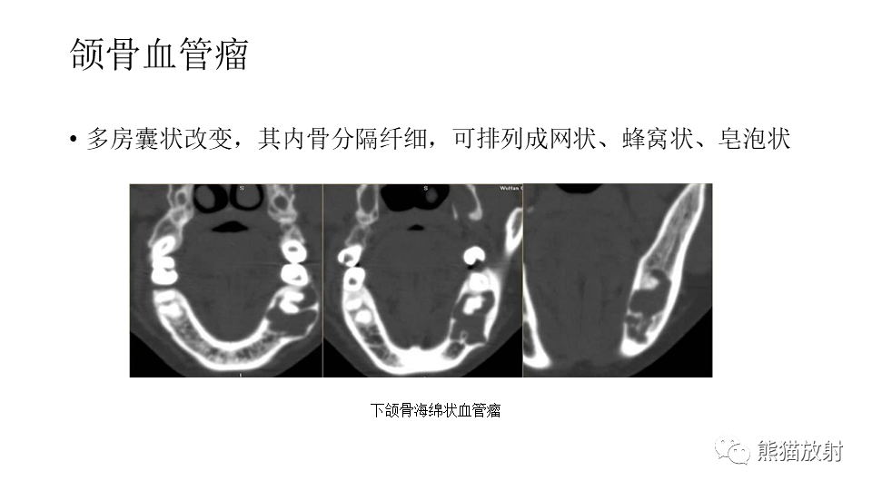 【病例】下颌骨成釉细胞瘤2例CT-31