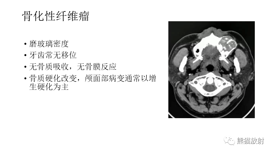 【病例】下颌骨成釉细胞瘤2例CT-29