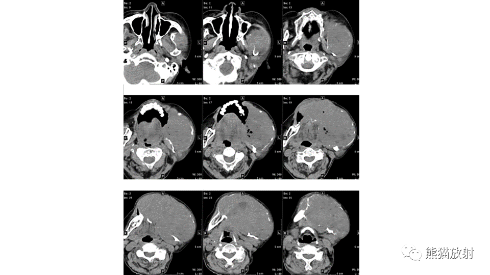 【病例】下颌骨成釉细胞瘤2例CT-3