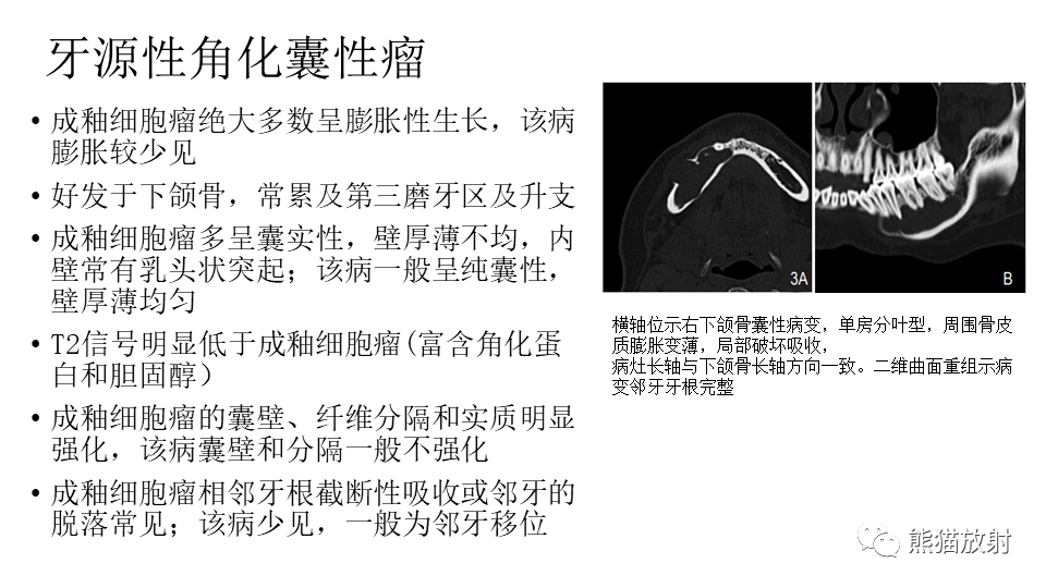 【病例】下颌骨成釉细胞瘤2例CT-26