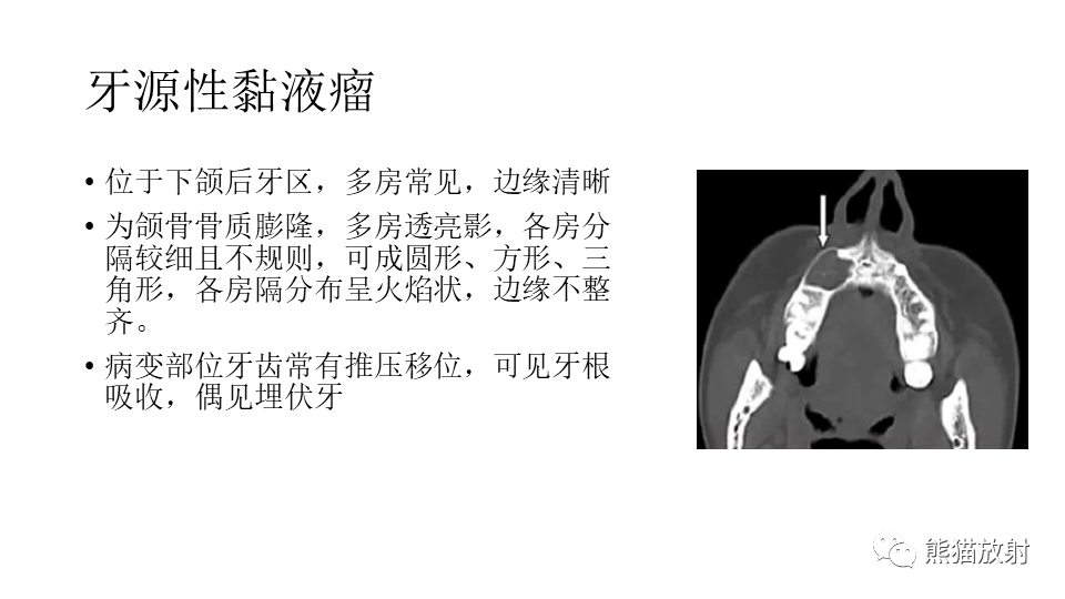 【病例】下颌骨成釉细胞瘤2例CT-28