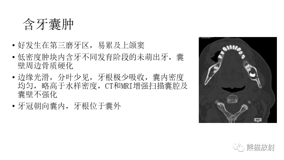 【病例】下颌骨成釉细胞瘤2例CT-27