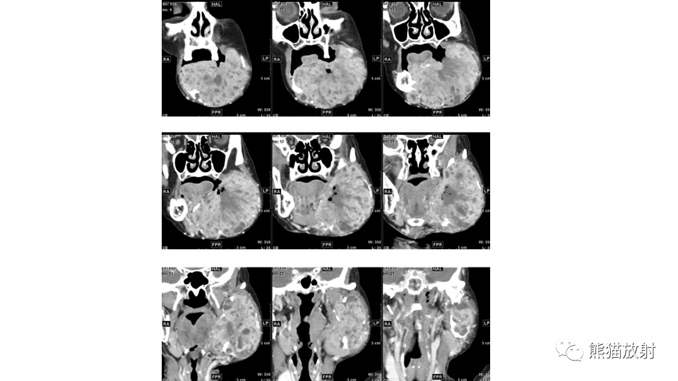 【病例】下颌骨成釉细胞瘤2例CT-6