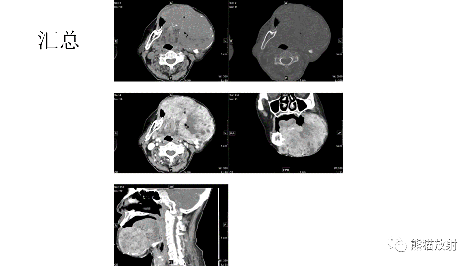 【病例】下颌骨成釉细胞瘤2例CT-8