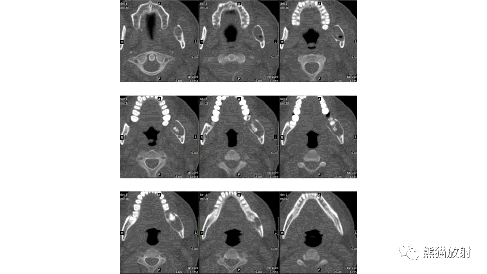【病例】下颌骨成釉细胞瘤2例CT-12