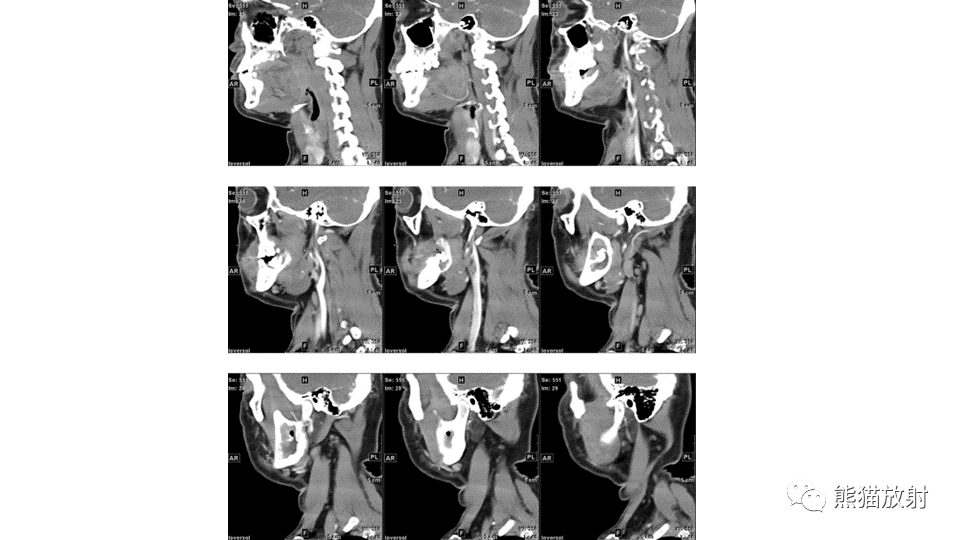 【病例】下颌骨成釉细胞瘤2例CT-15