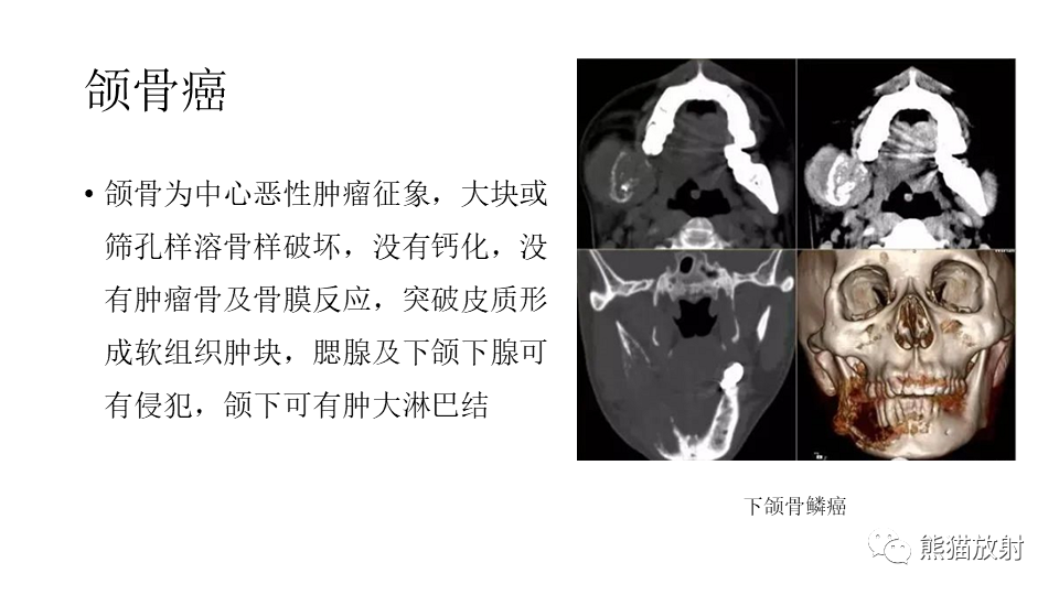 【病例】下颌骨成釉细胞瘤2例CT-32
