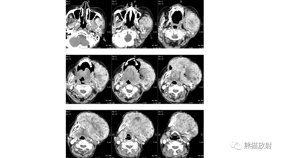 【病例】下颌骨成釉细胞瘤2例CT-5