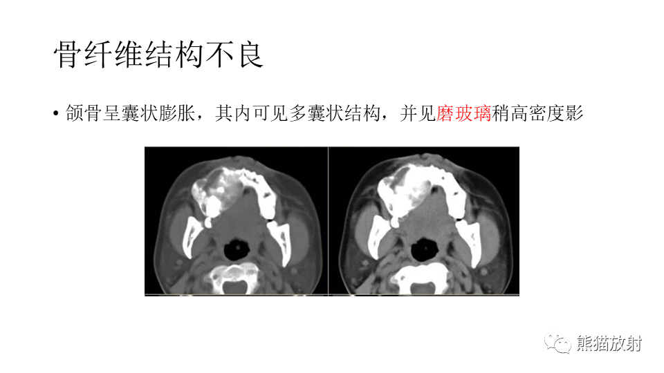 【病例】下颌骨成釉细胞瘤2例CT-30