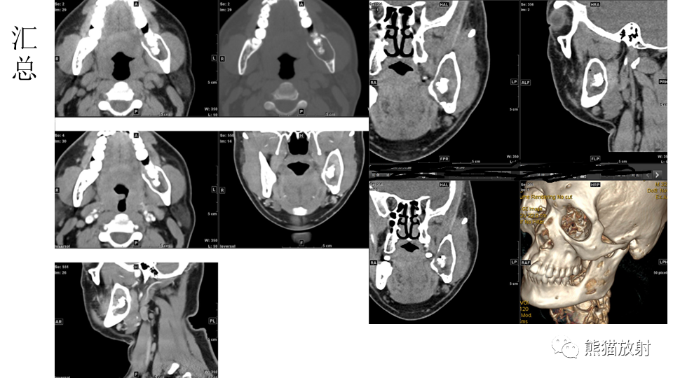 【病例】下颌骨成釉细胞瘤2例CT-16