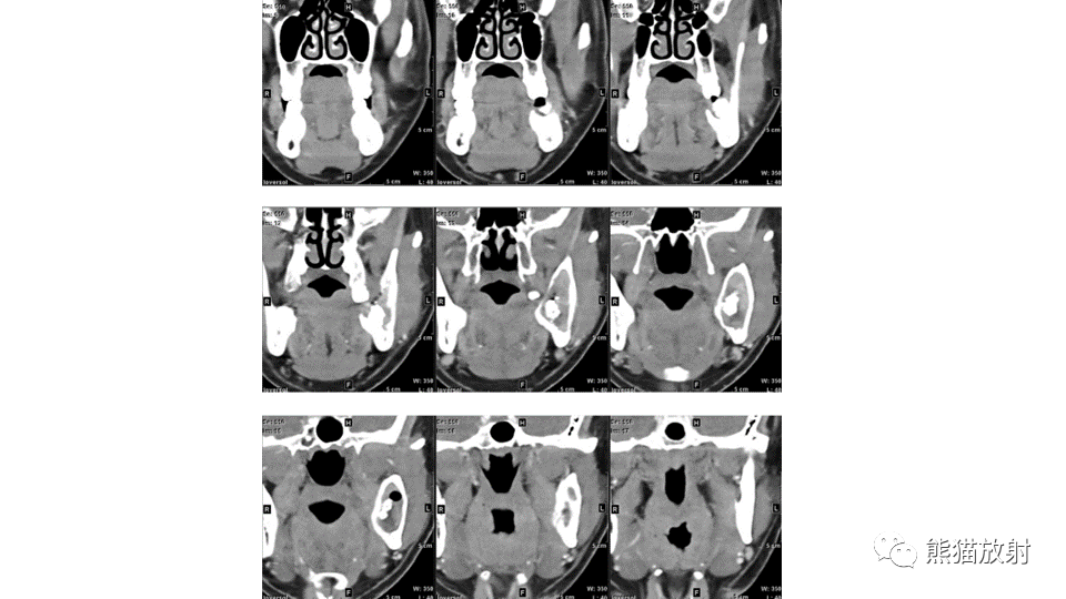 【病例】下颌骨成釉细胞瘤2例CT-14