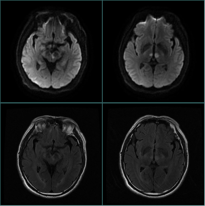 【病例】双侧丘脑梗死—Percheron动脉梗死1例MR影像-1 【病例】双侧丘脑梗死—Percheron动脉梗死1例MR影像-1