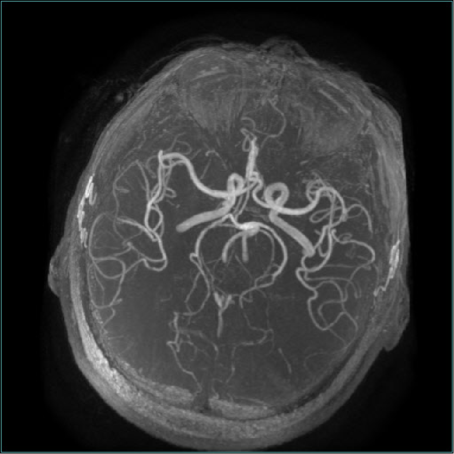 【病例】双侧丘脑梗死—Percheron动脉梗死1例MR影像-2 【病例】双侧丘脑梗死—Percheron动脉梗死1例MR影像-2