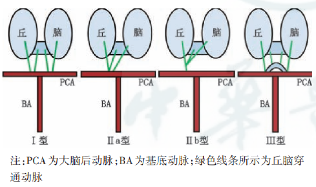 【病例】双侧丘脑梗死—Percheron动脉梗死1例MR影像-4 【病例】双侧丘脑梗死—Percheron动脉梗死1例MR影像-4