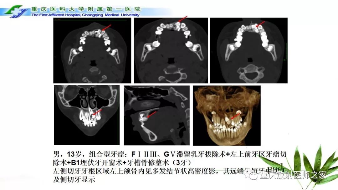 【PPT】颌骨常见肿瘤及肿瘤样病变的CT诊断及鉴别诊断-21