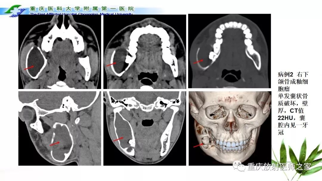 【PPT】颌骨常见肿瘤及肿瘤样病变的CT诊断及鉴别诊断-27